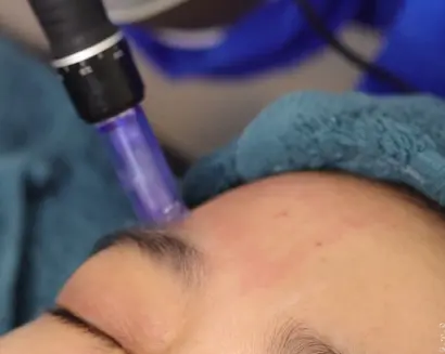 Rawatan microneedling untuk parut jerawat lekuk