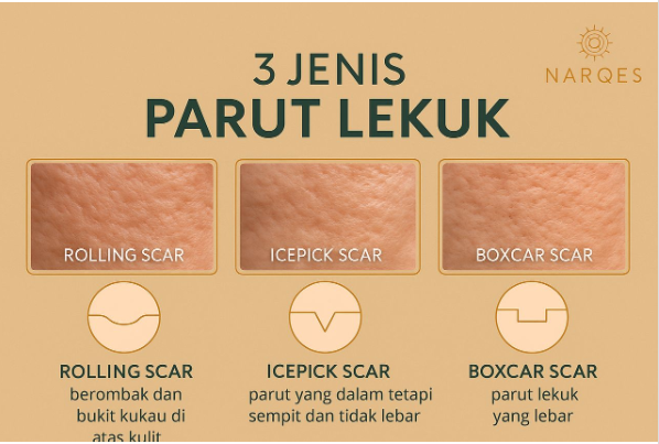Jenis parut jerawat lekuk - ice pick, boxcar dan rolling scar