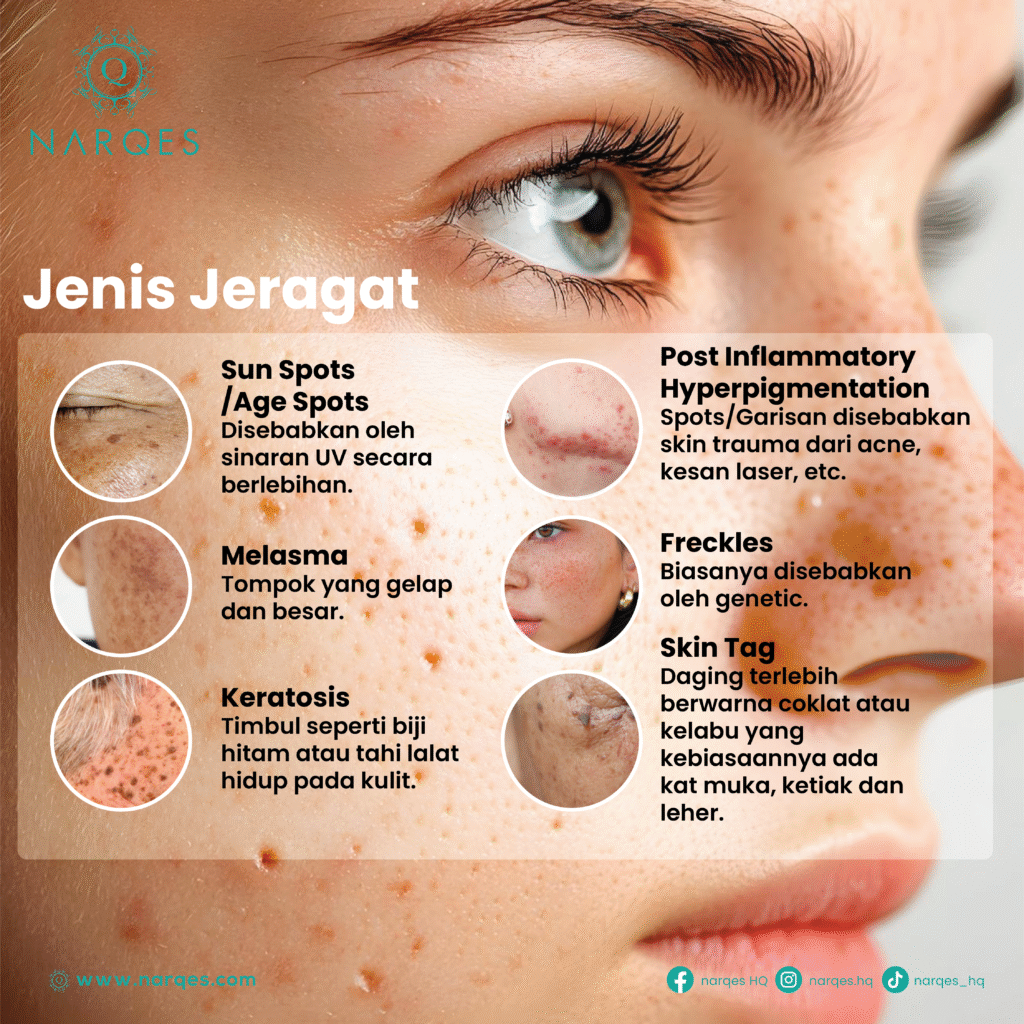 Cara Hilangkan Jeragat Degil: Panduan Lengkap & Rawatan Paling Berkesan di Narqes Aesthetic