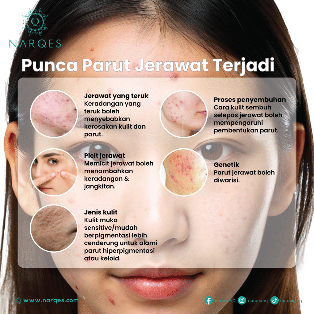 Rawatan Parut Jerawat | Cara Hilangkan Parut Berlubang & Parut Hitam Dengan Berkesan